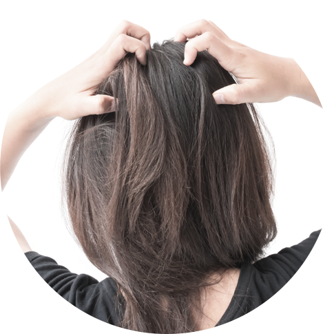 頭皮のかゆみ改善